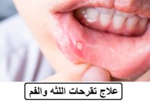 علاج تقرحات اللثه والفم
