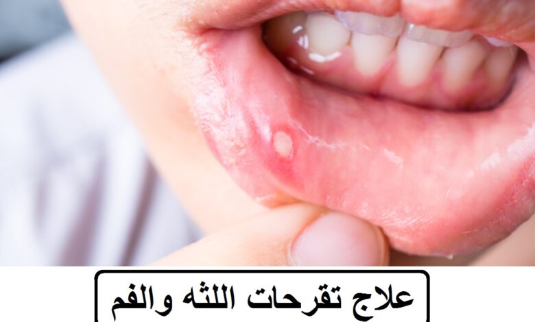علاج تقرحات اللثه والفم