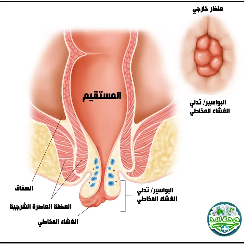 ماهي البواسير؟