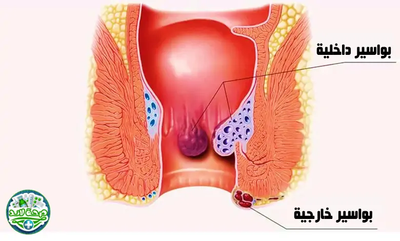 بواسير داخلية وخارجية