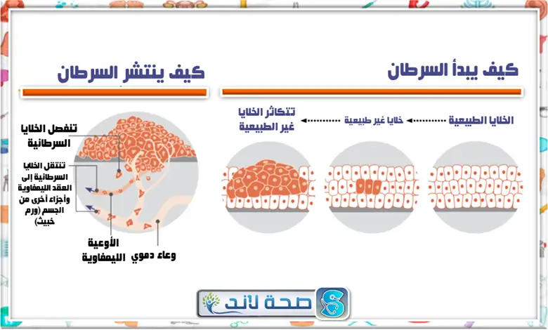 كيف يبدء ويتطور السرطان