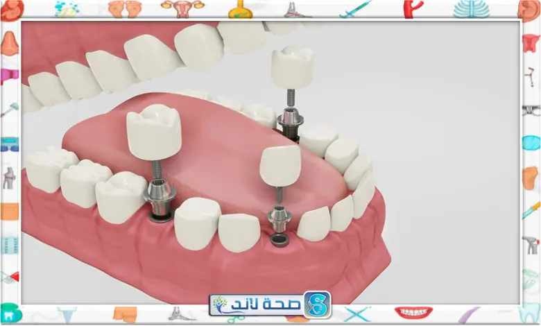 زراعة الاسنان: كل ما تحتاج معرفته لابتسامة رائعة ومستدامة