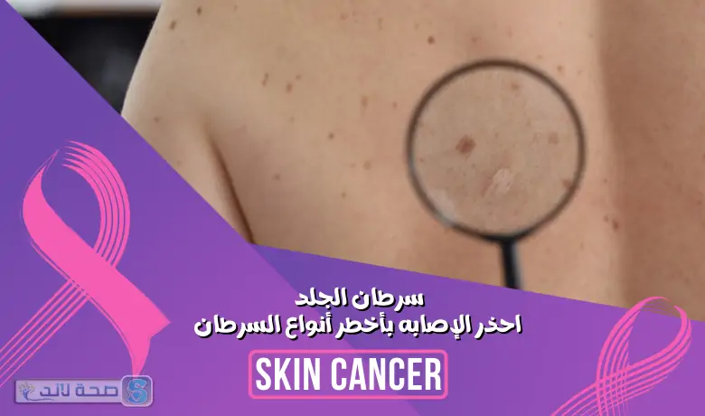 سرطان الجلد .. احذر الإصابه بأخطر أنواع السرطان