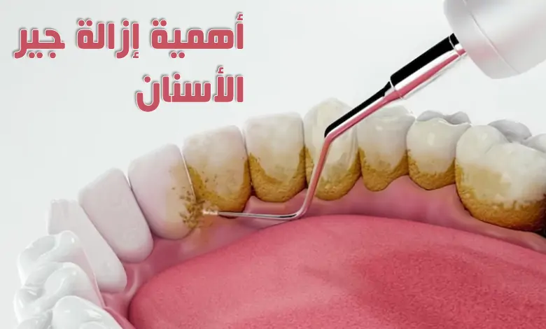 أهمية إزالة جير الأسنان .. 5 خطوات عليك الإلتزام بها