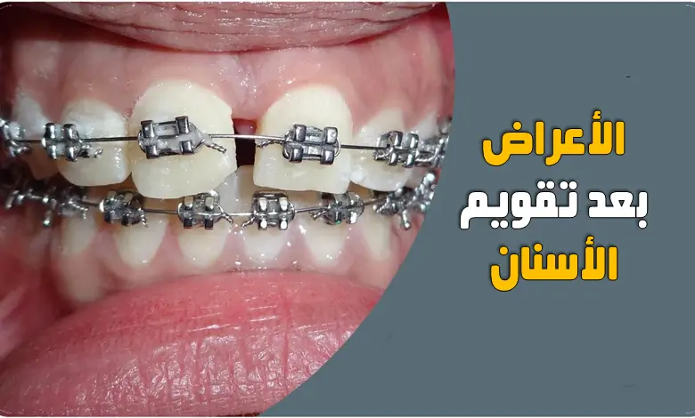 الأعراض بعد تقويم الأسنان