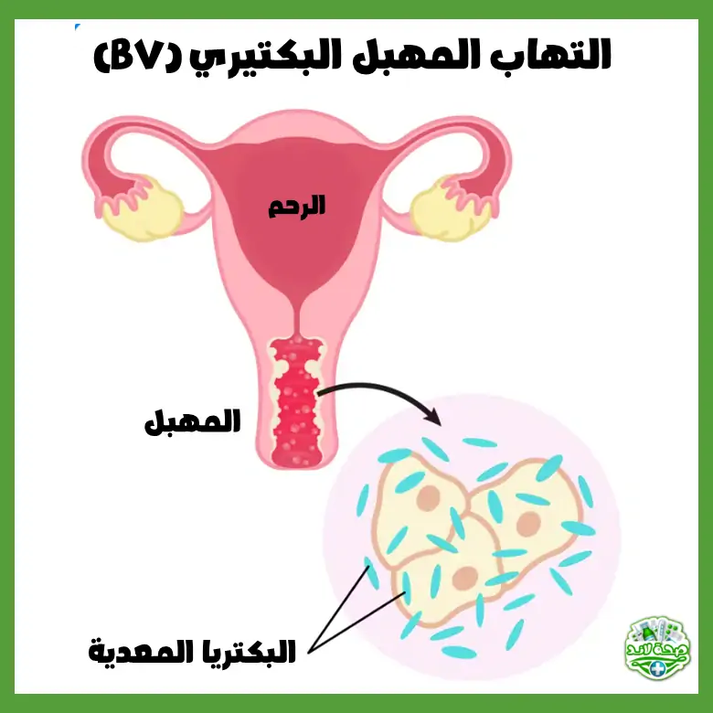 ما هو التهاب المهبل البكتيري (BV)؟