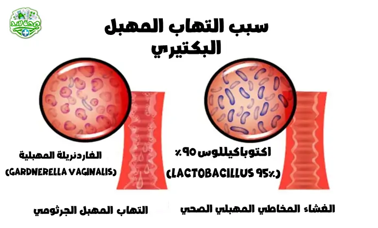 ما الذي يسبب التهاب المهبل الجرثومي (BV)؟