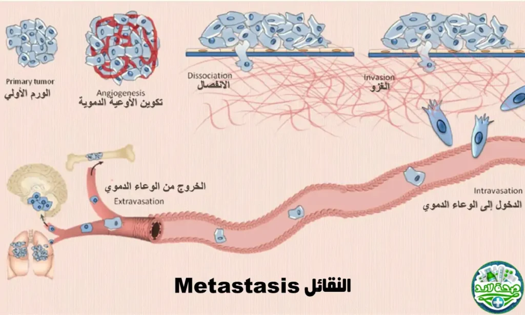 الانتشار والانتقال (Metastasis)