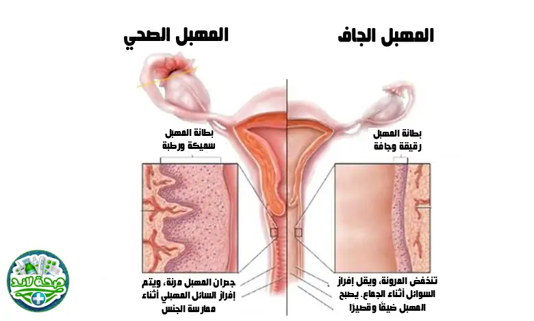 أعراض جفاف المهبل
