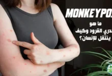 ما هو جدري القرود (Monkeypox) وما هي أعراضه وطرق علاجة؟