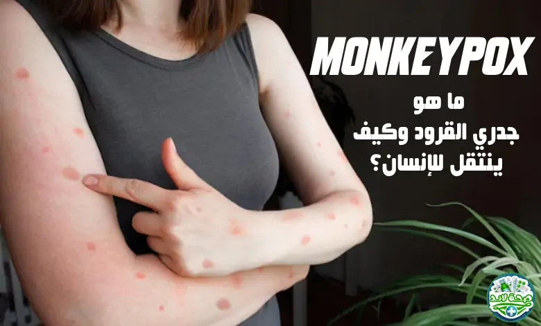 ما هو جدري القرود (Monkeypox) وما هي أعراضه وطرق علاجة؟