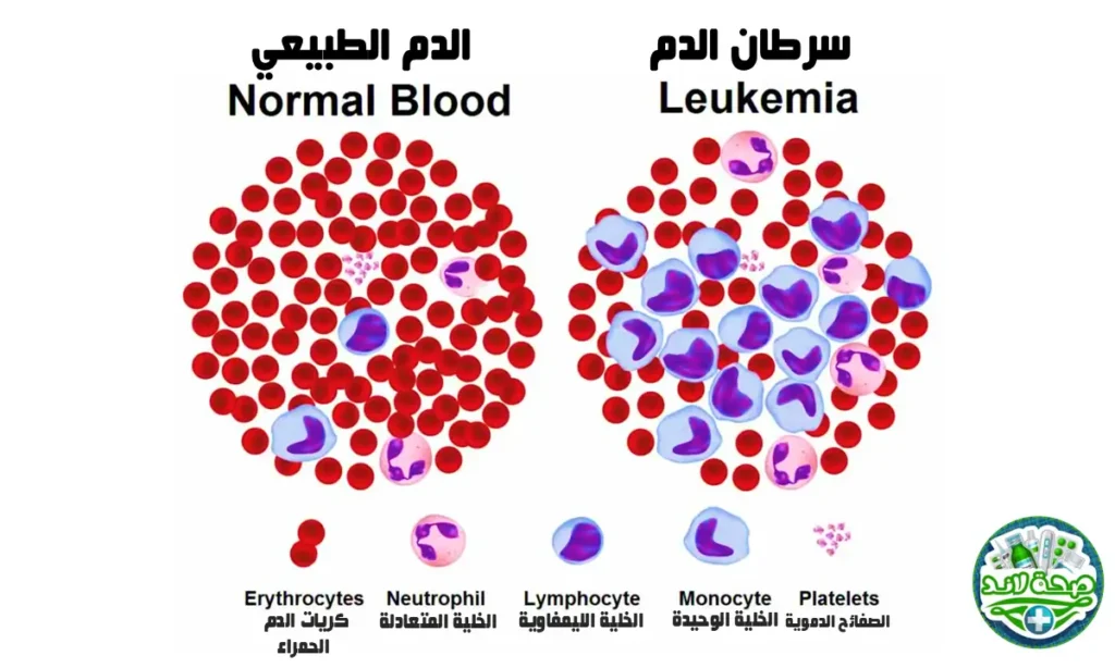 مقارنة بين خلايا الدم الطبيعية وخلايا الدم لدى مريض اللوكيميا