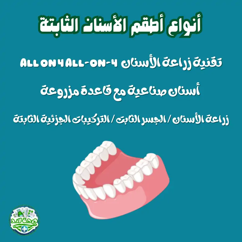 أنواع أطقم الأسنان الثابتة