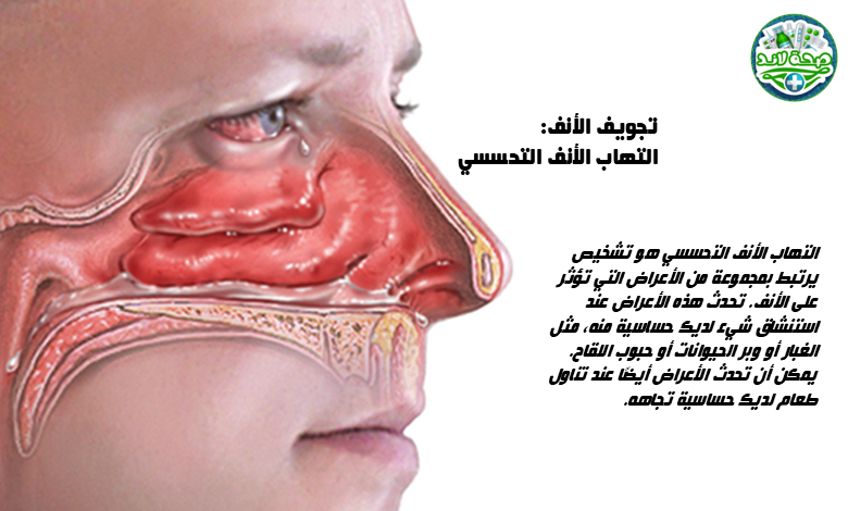 ما هو التهاب الأنف التحسسي؟