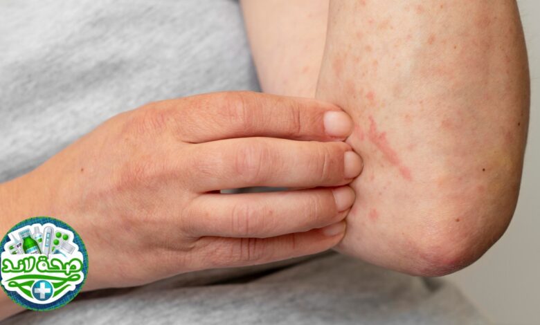 كيفية التخلص من حكة الجسم : 10 تدابير للتخلص من حكة الجلد