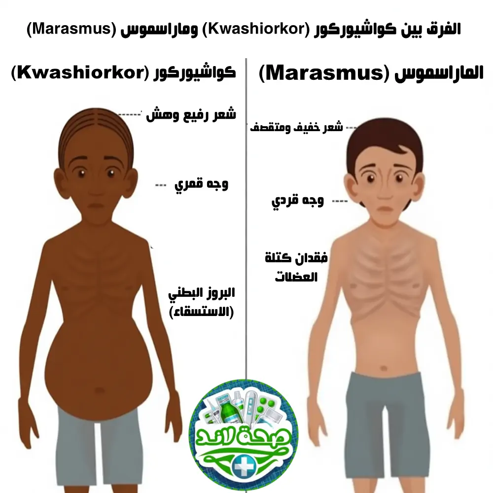 الفرق بين الكواشيوركوروالماراسموس
