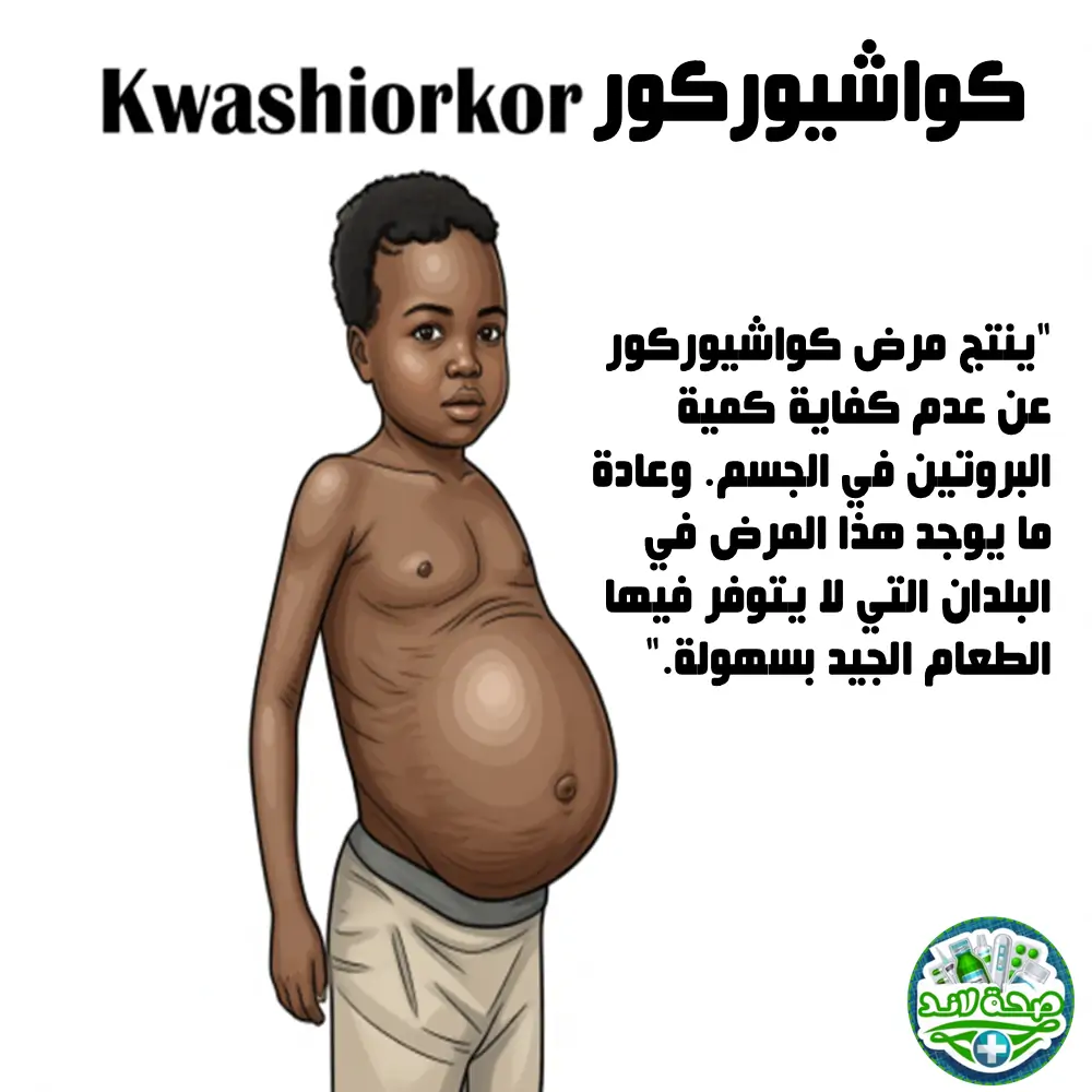 ما هو مرض الكواشيوركور (Kwashiorkor)؟