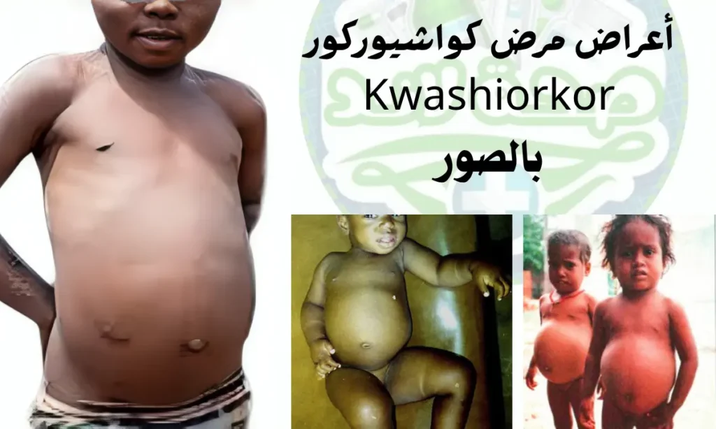 أعراض مرض کواشیورکور Kwashiorkor بالصور