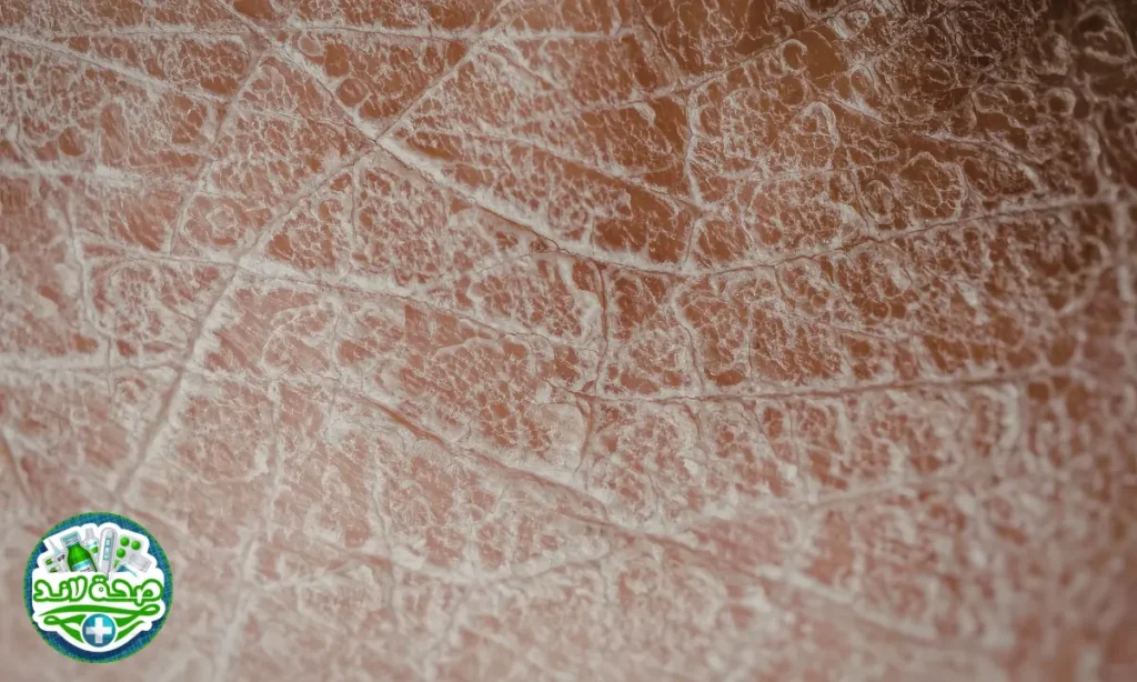 شكل البشرة الجافة