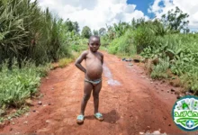 مرض كواشيوركور(Kwashiorkor): دليل مبسط لفهم أحد أمراض سوء التغذية وكيف يعالج