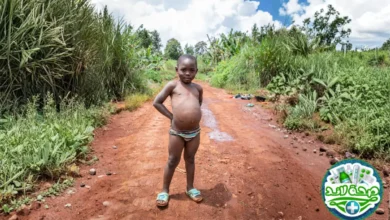 مرض كواشيوركور(Kwashiorkor): دليل مبسط لفهم أحد أمراض سوء التغذية وكيف يعالج