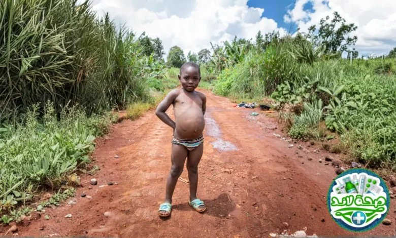 مرض كواشيوركور(Kwashiorkor): دليل مبسط لفهم أحد أمراض سوء التغذية وعلاجه