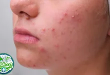 طرق علاج حب الشباب للبشرة الدهنية وكيفية الوقاية منه من خبراء صحة لاند