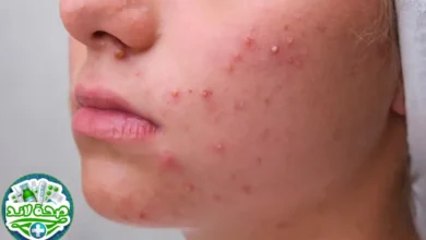 طرق علاج حب الشباب للبشرة الدهنية وكيفية الوقاية منه من خبراء صحة لاند