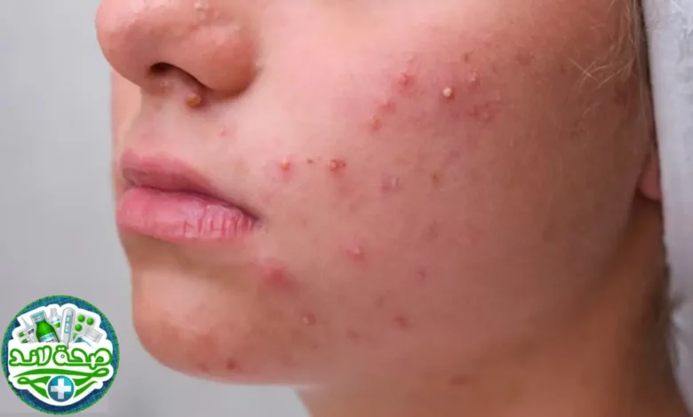 طرق علاج حب الشباب للبشرة الدهنية وكيفية الوقاية منه من خبراء صحة لاند