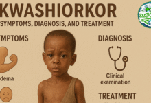 كواشيوركور Kwashiorkor نوع من سوء التغذية اعراض وتشخيص وطرق علاجه