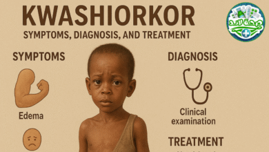كواشيوركور Kwashiorkor نوع من سوء التغذية اعراض وتشخيص وطرق علاجه