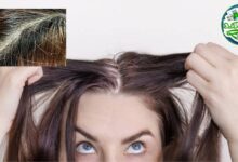 الشيب المبكر: أسبابه، طرق علاجه والوقاية منه