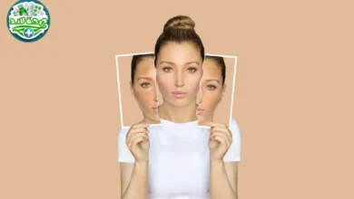 الكلف (Melasma): الأسباب، الأنواع، التشخيص، وطرق العلاج الطبية