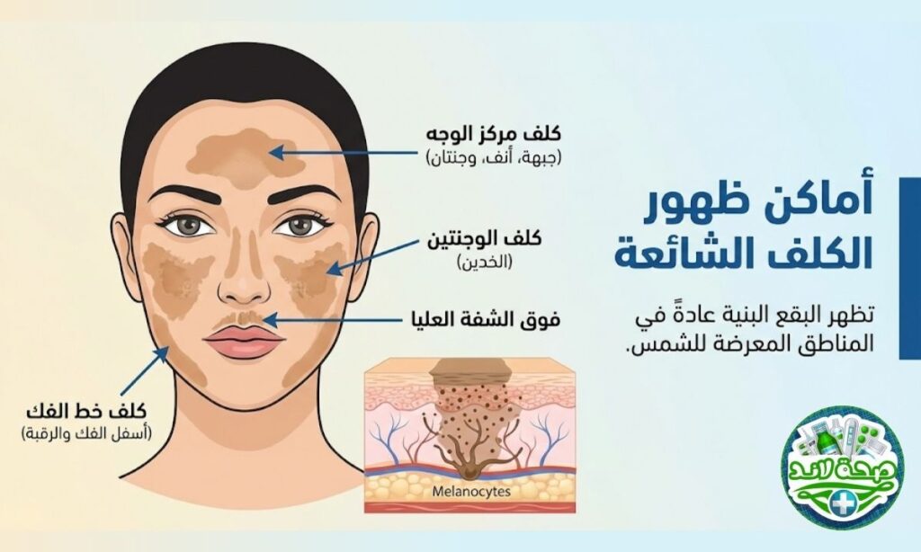 أماكن ظهور الكلف