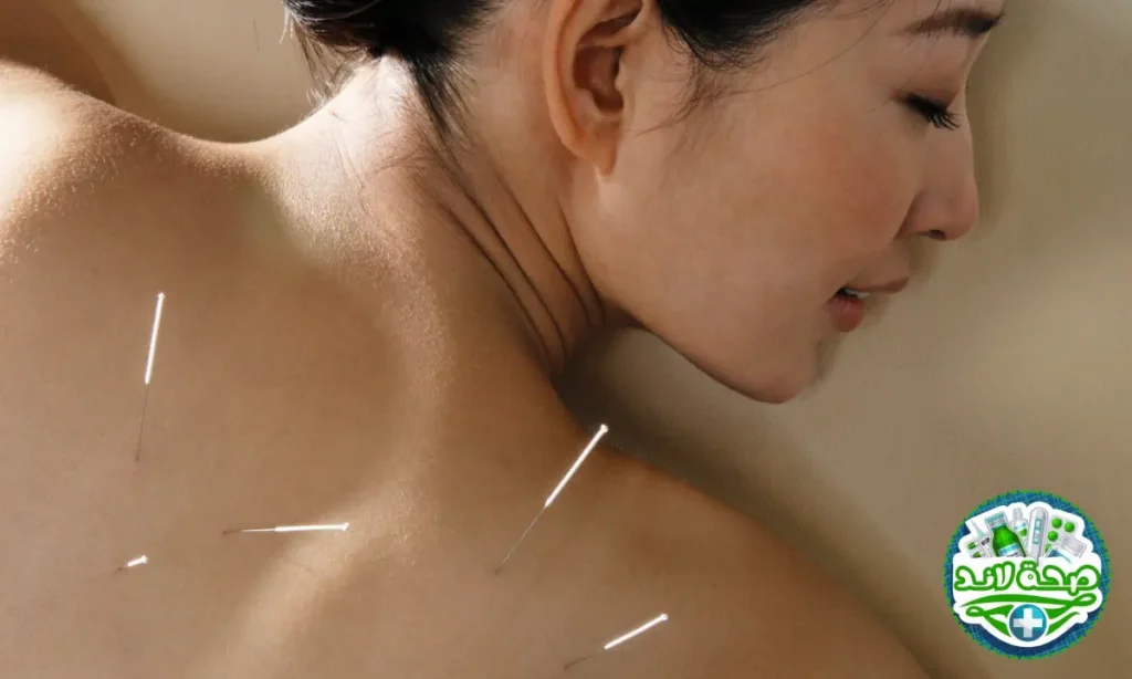 الوخز بالإبر (Acupuncture)