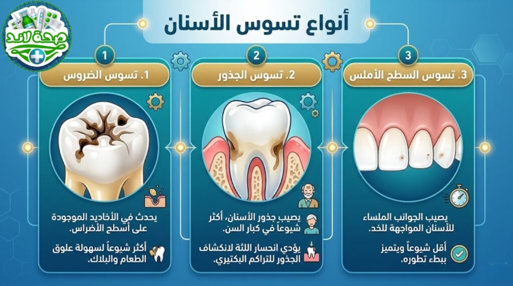 أنواع تسوس الأسنان