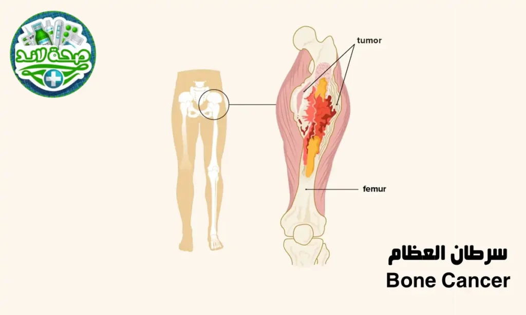 سرطان العظام (Bone Cancer)