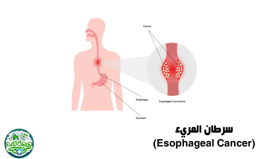 (Esophageal Cancer)