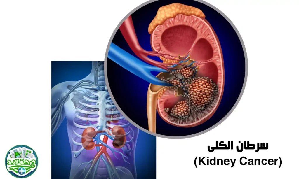أنواع السرطان الخطيرة : سرطان الكلى (Kidney Cancer)