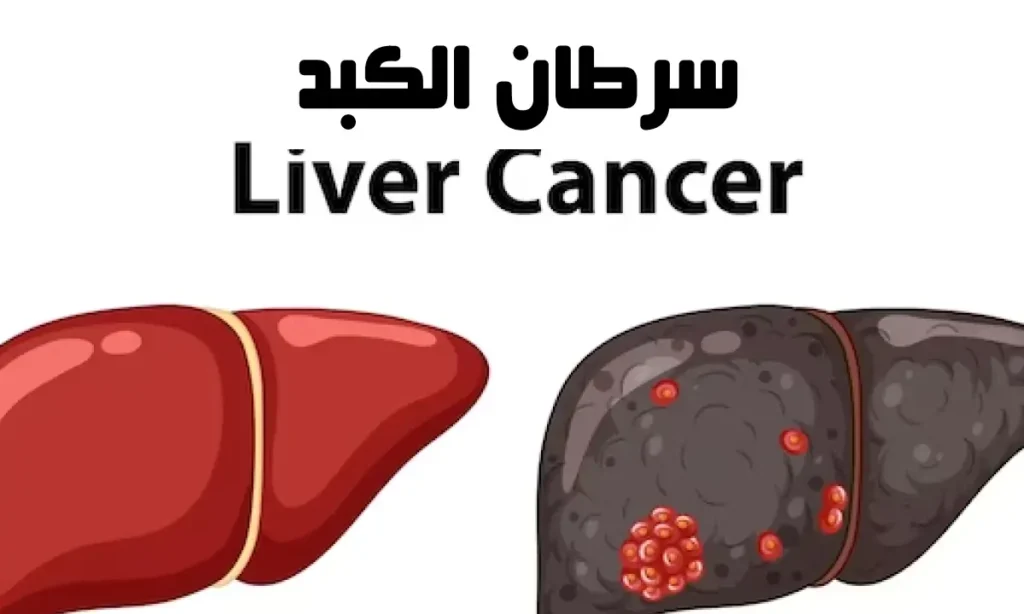 أنواع السرطان : سرطان الكبد (Liver Cancer)