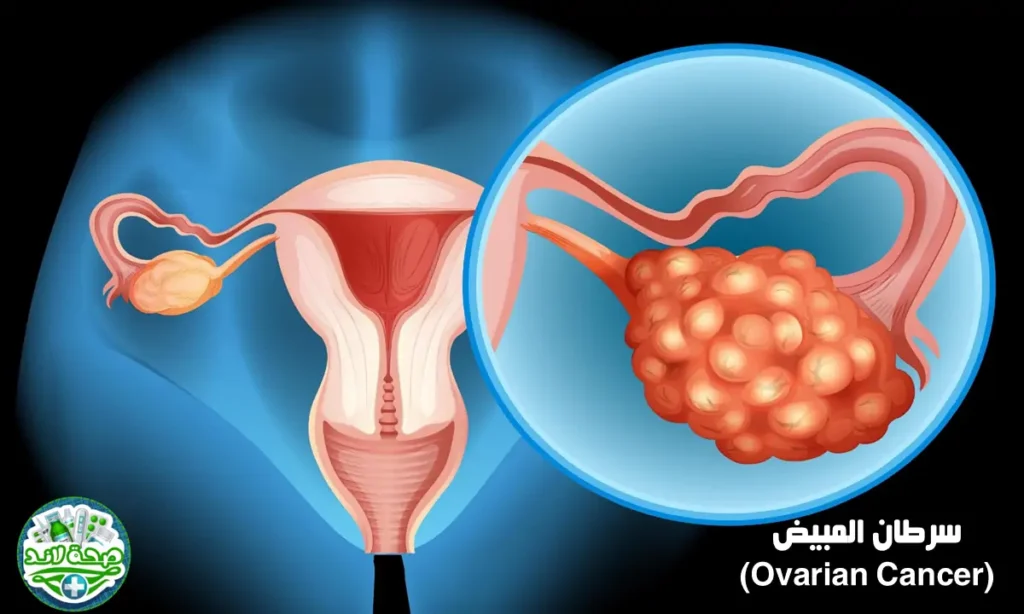 Ovarian Cancer