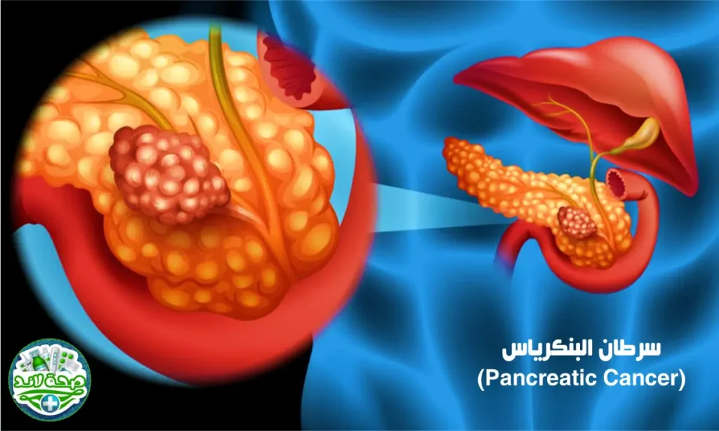 سرطان البنكرياس (Pancreatic Cancer)