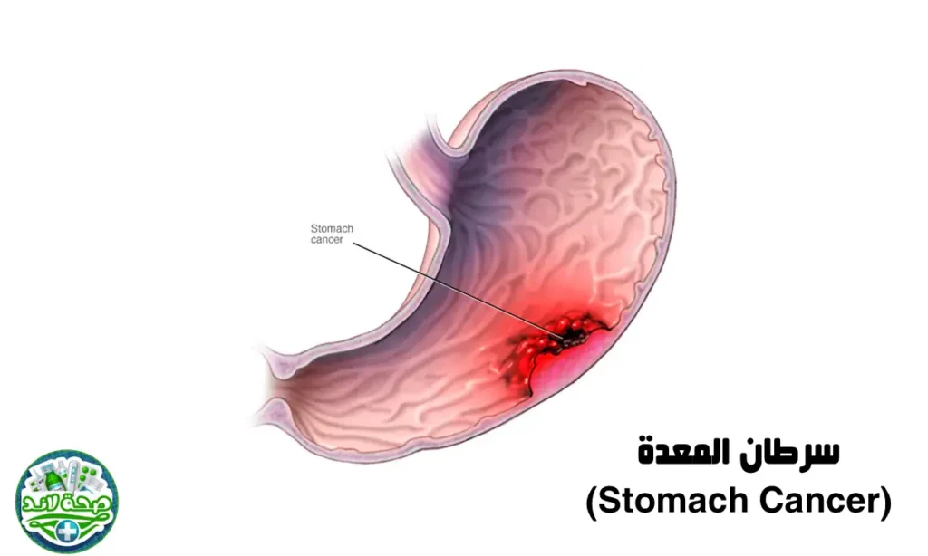 Stomach Cancer