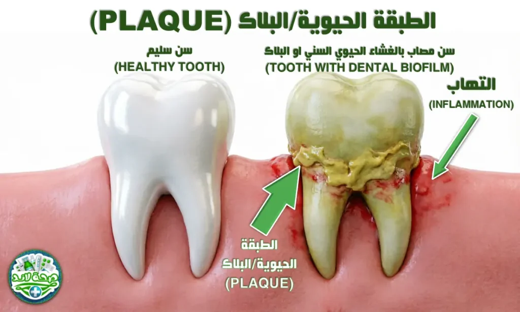 كيفية تشكل البلاك على السن