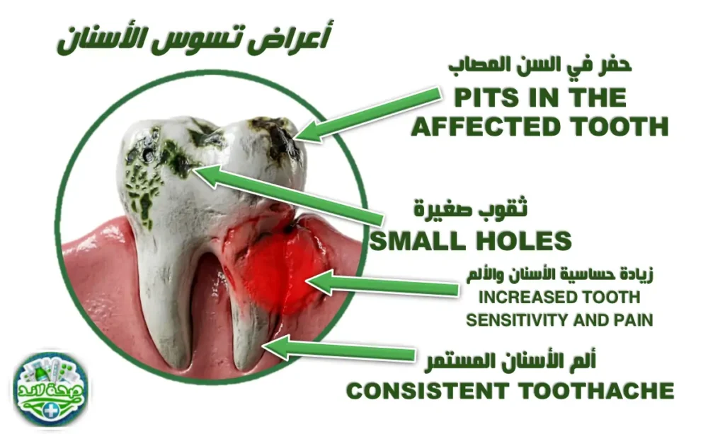 أعراض تسوس الأسنان