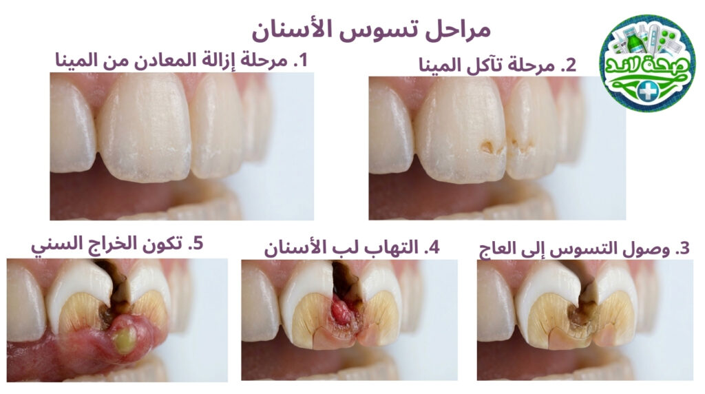 مراحل تسوس الأسنان