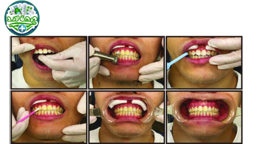 علاج تسوس الأسنان المبكر