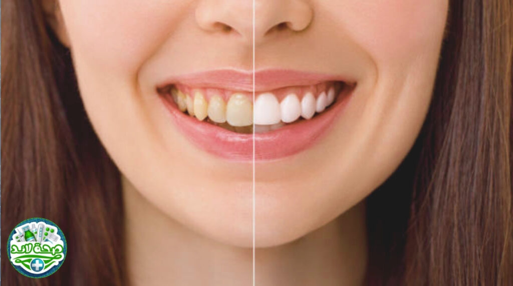 ما هو تبييض الأسنان؟