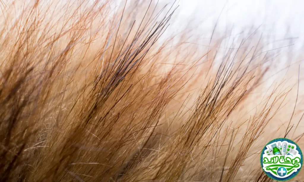 العناية بالشعر الدهني