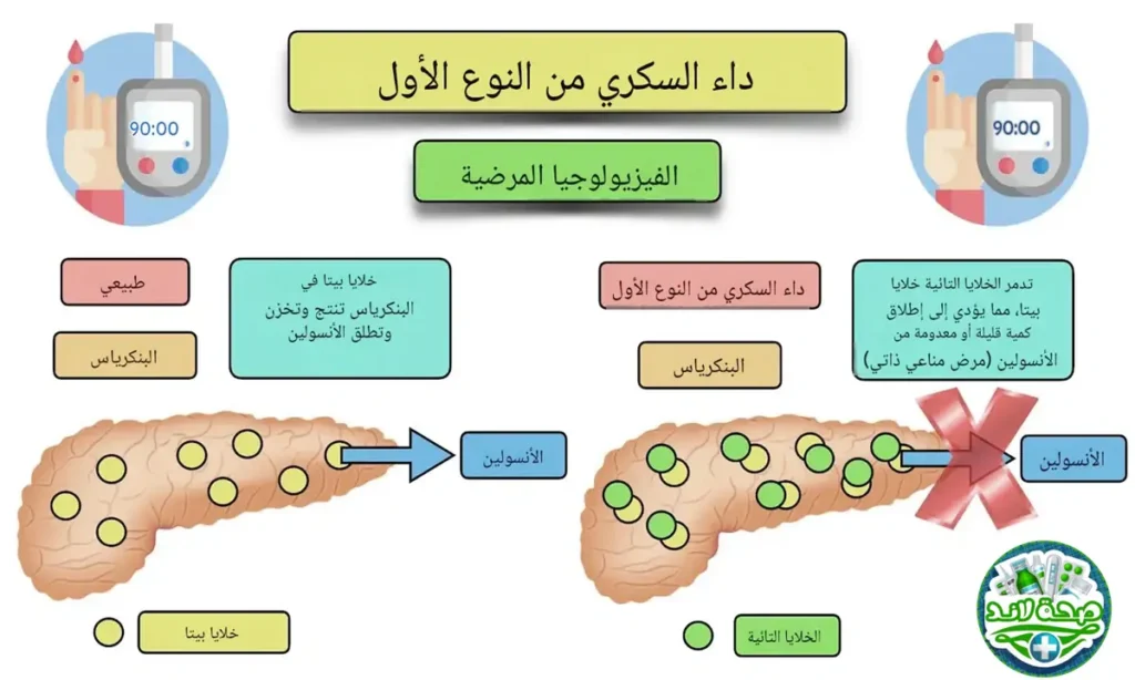 فسيولوجيا مرض السكري من النوع الأول